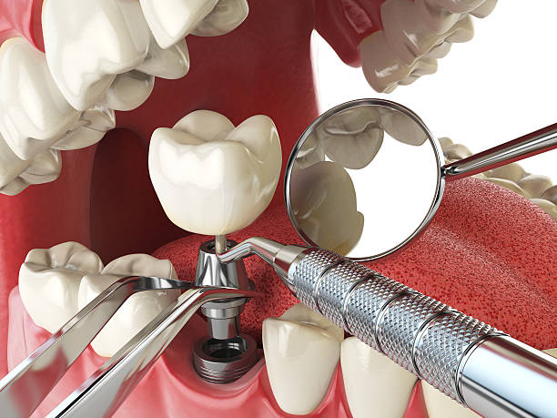 Best Emergency Dentist for Lost Fillings or Crowns in Mianna, AR